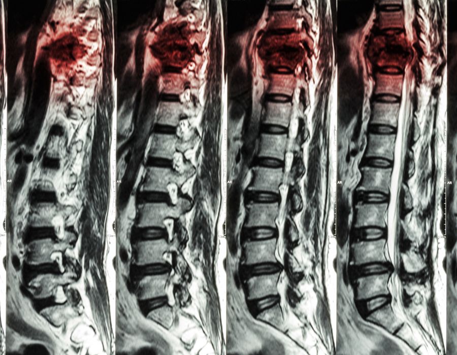 spinal cord injury xray